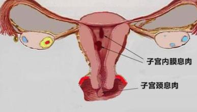  如何发现宫颈息肉的早期症状呢？